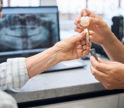 Budowa implantu zęba – co warto wiedzieć? Budowa implantu zęba – co warto wiedzieć?
